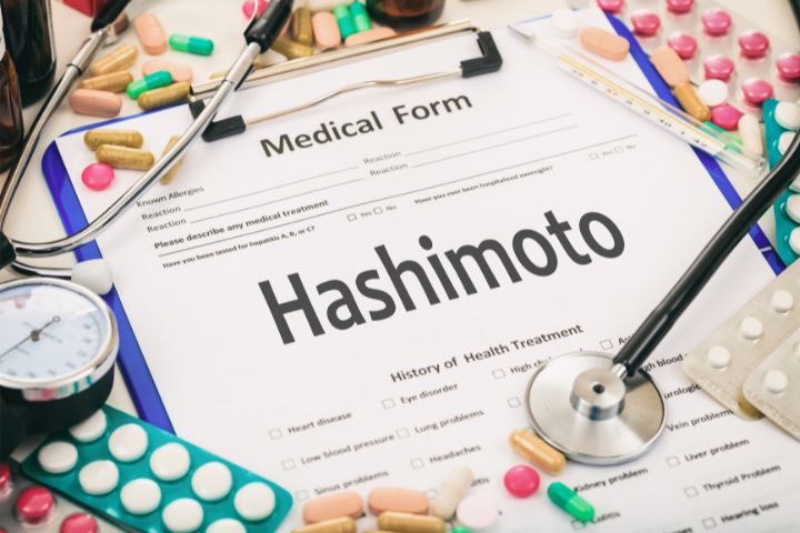 تیروئیدیت هاشیموتو یک اختلال شایع غده تیروئید است
